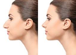 rinoplastie