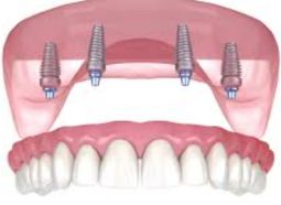 implant dentar