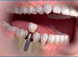 implant dentar