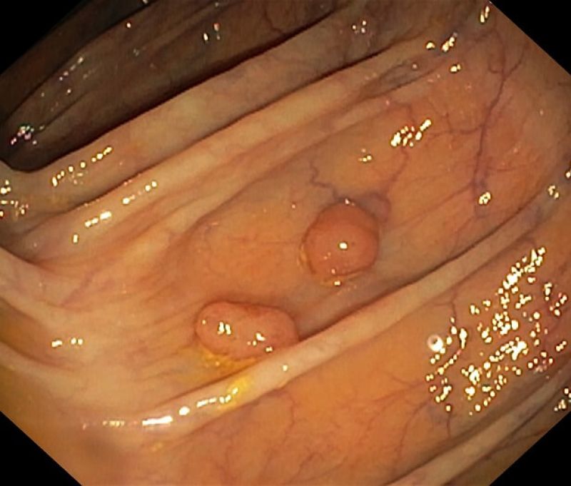 Riscul de cancer colonic creşte proporţional cu numărul de polipi adenomatoşi prezenţi în colon