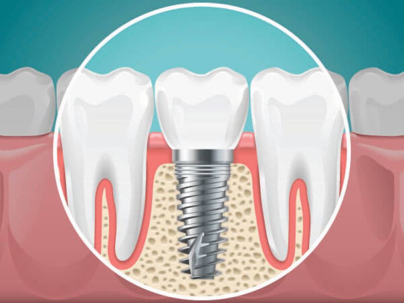 Implant