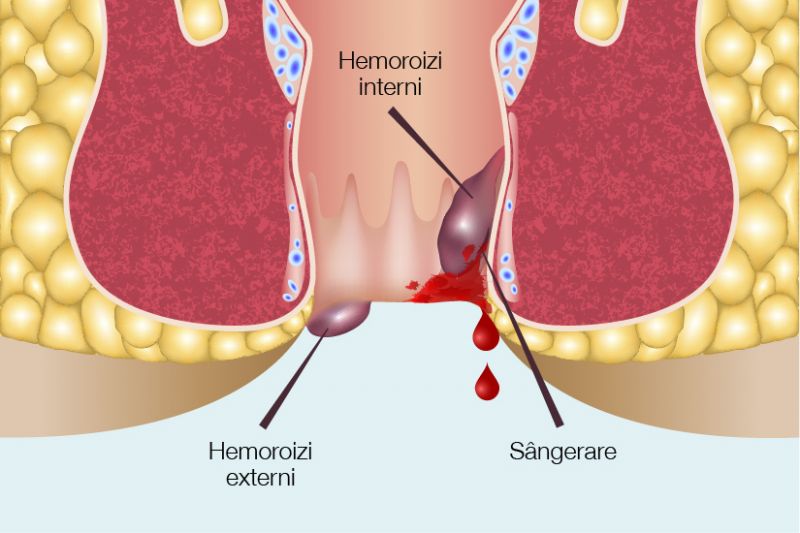 tratament hemoroizi si fisuri anale