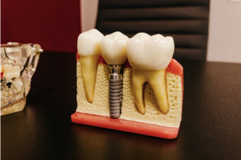 implant dentar