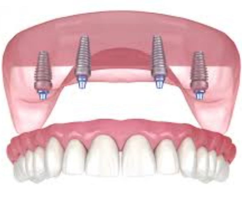 implant dentar