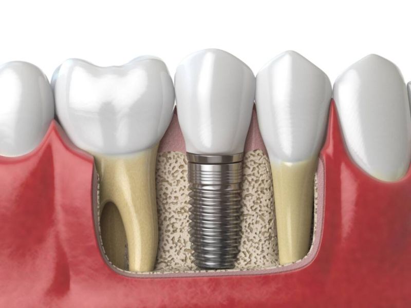 implant dentar