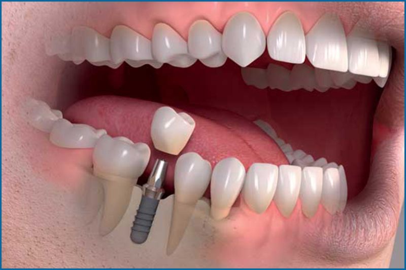 implant dentar